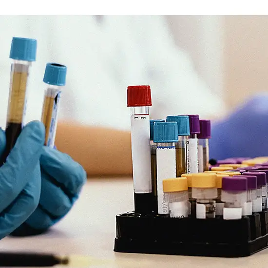 Human Leukocyte Antigen (HLA) Test